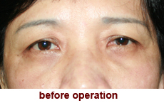 plastic-surgery-blepharoplasty